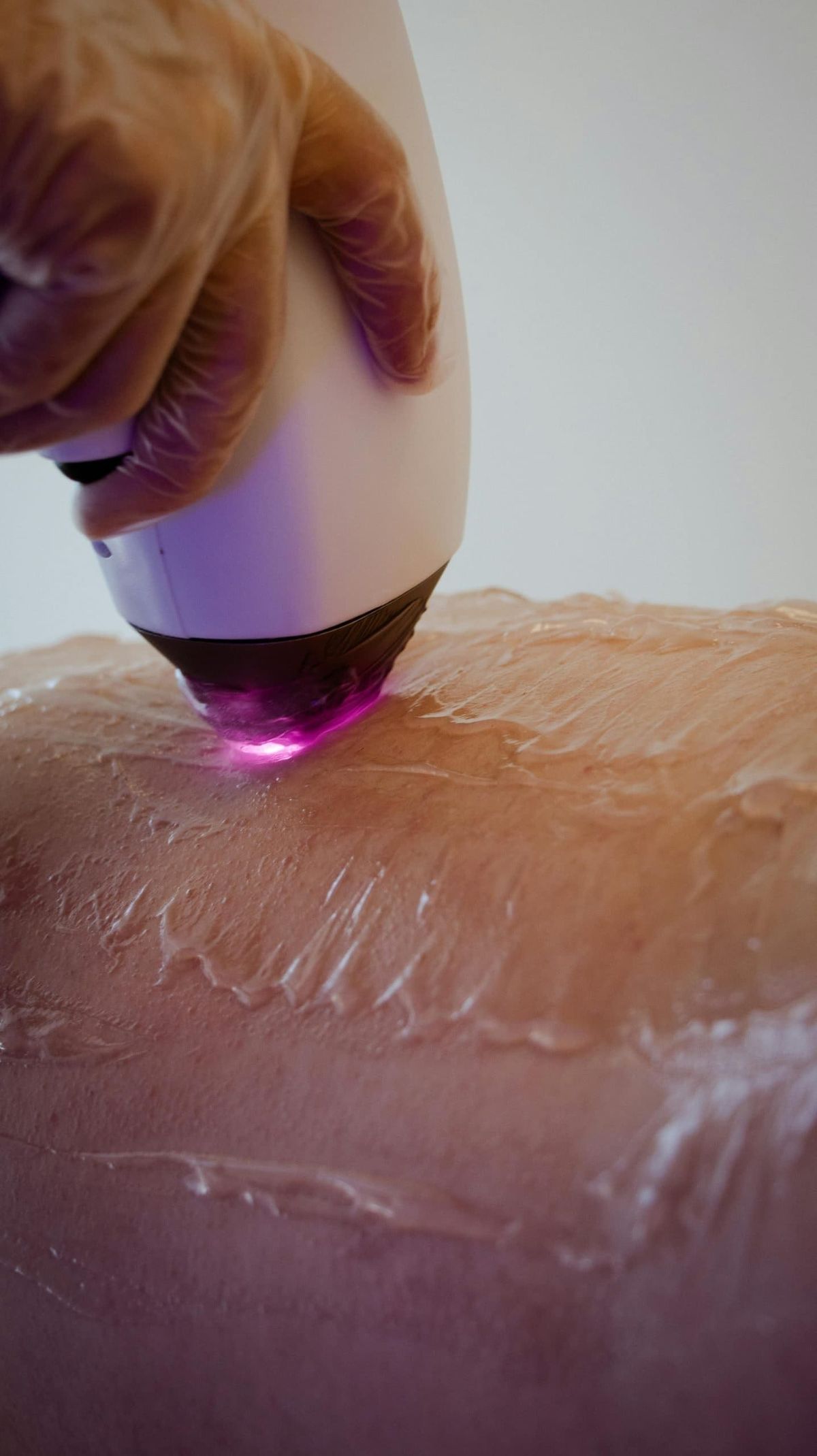 Close de procedimento de criolipólise com aplicador emitindo luz rosada sobre a pele coberta de gel, mão com luva conduzindo o equipamento, tons quentes e clínicos, fotografia de tratamento corporal profissional